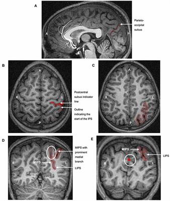 Effects of Prenatal Alcohol Exposure on the Volumes of the Lateral and Medial Walls of the Intraparietal Sulcus